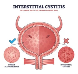 Interstitial Cystitis